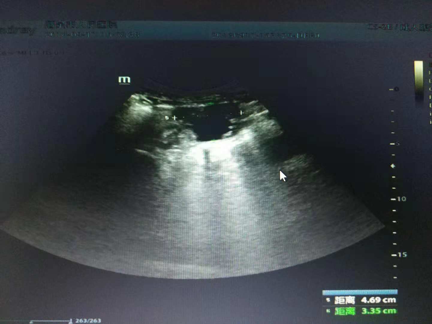 四、卵巢子宫内膜异位囊肿(混合型)-临床超声诊断学-医学